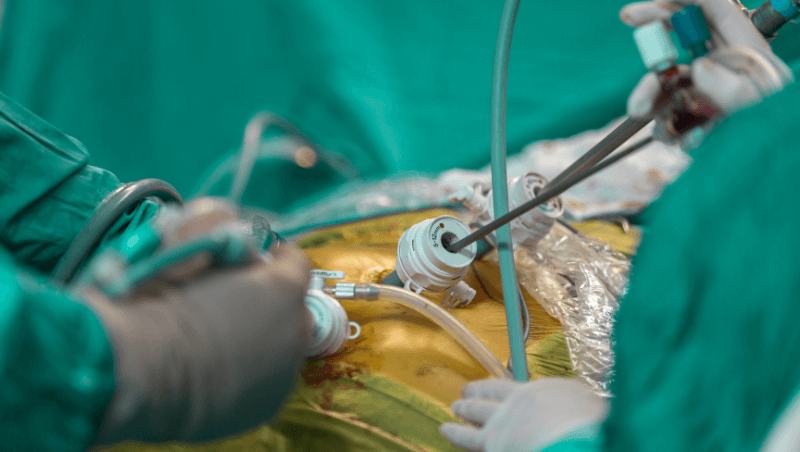 Laparoscopic Appendicectomy