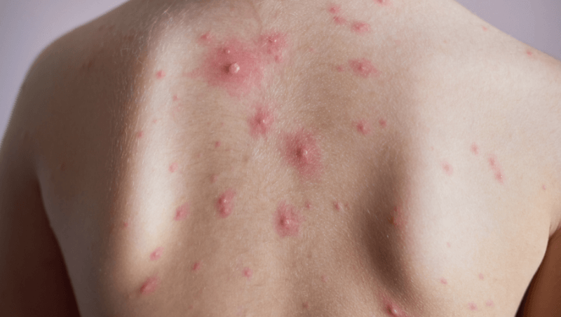 Chickenpox Treatment